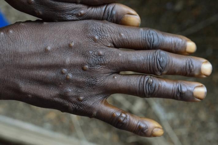 Santé : La variole du singe affecte profondément le système de santé et la sécurité publique en RDC 